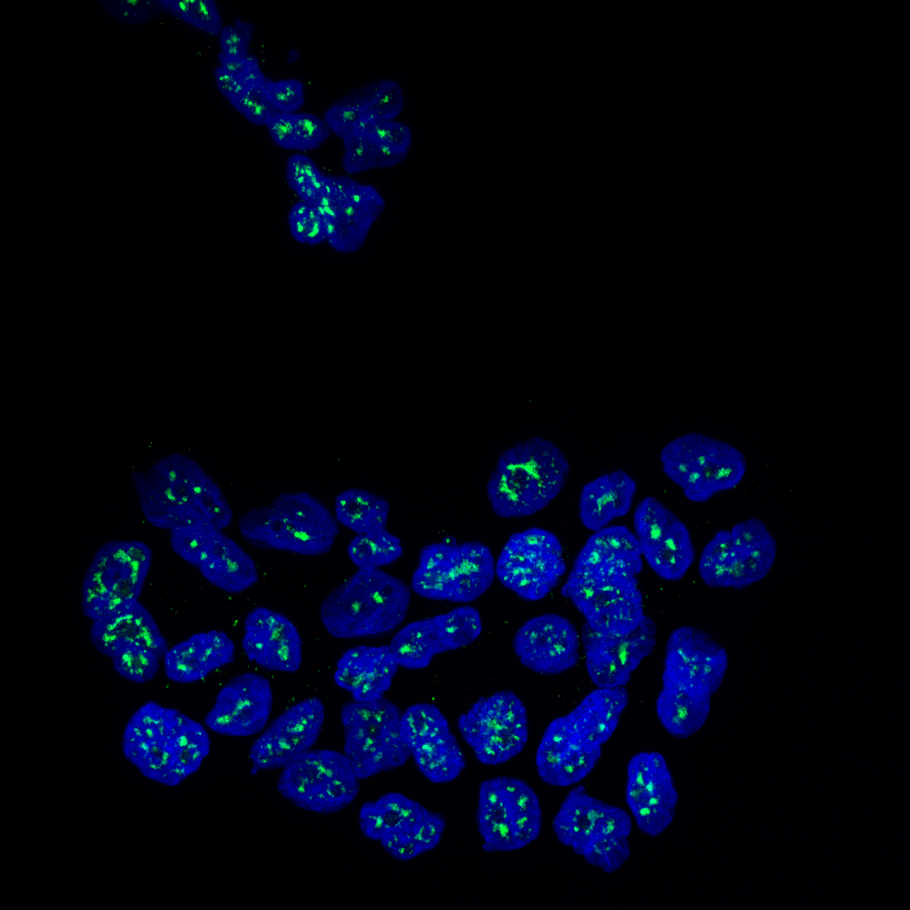 Identifican una proteína que mantiene dormidas las células metastásicas del cáncer de mama