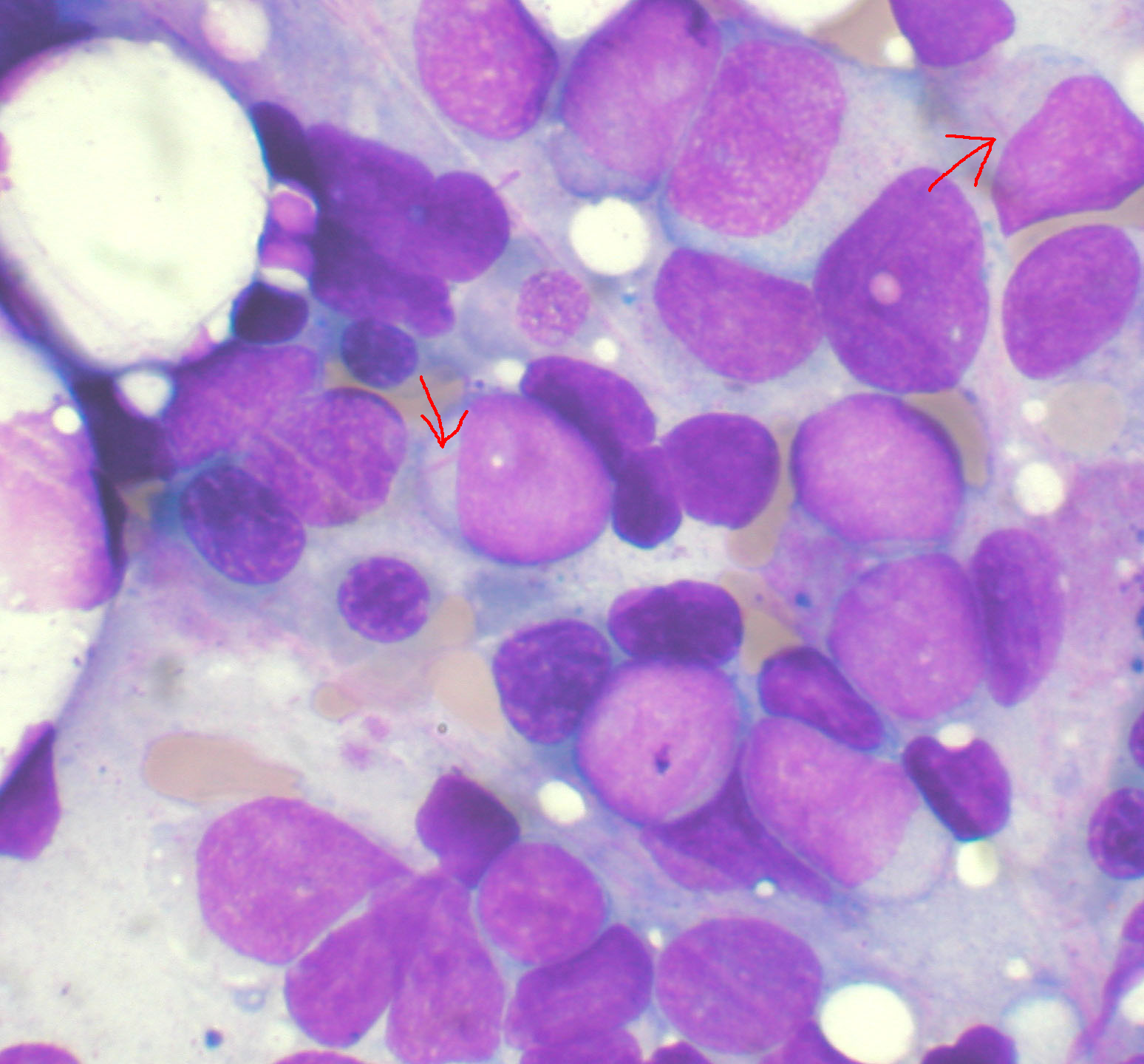 Cambios genéticos podrían predecir el riesgo de Leucemia Mieloide Aguda años antes del diagnóstico