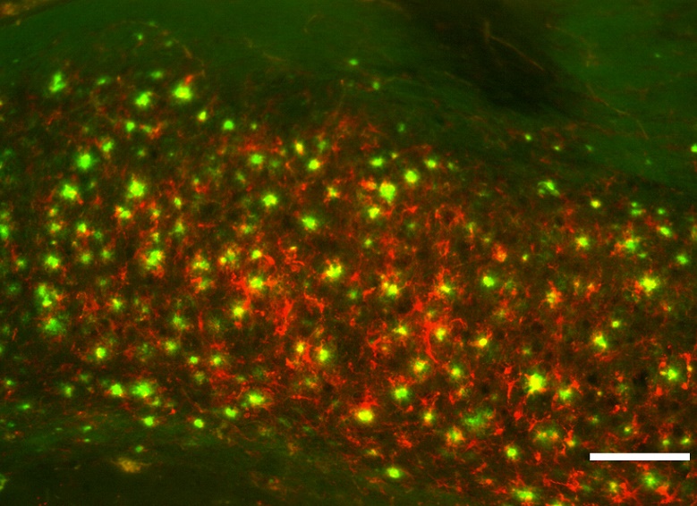 Nanopartículas para detectar la enfermedad de Alzheimer con resonancia magnética