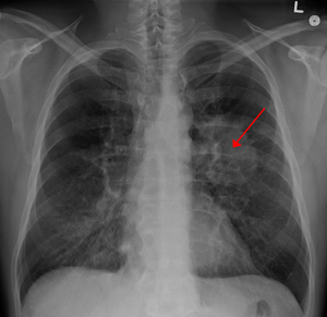 Un estudio interCIBER determina que existe un aumento en la actividad metabólica y una respuesta inflamatoria en el tejido tumoral del cáncer de pulmón no microcítico