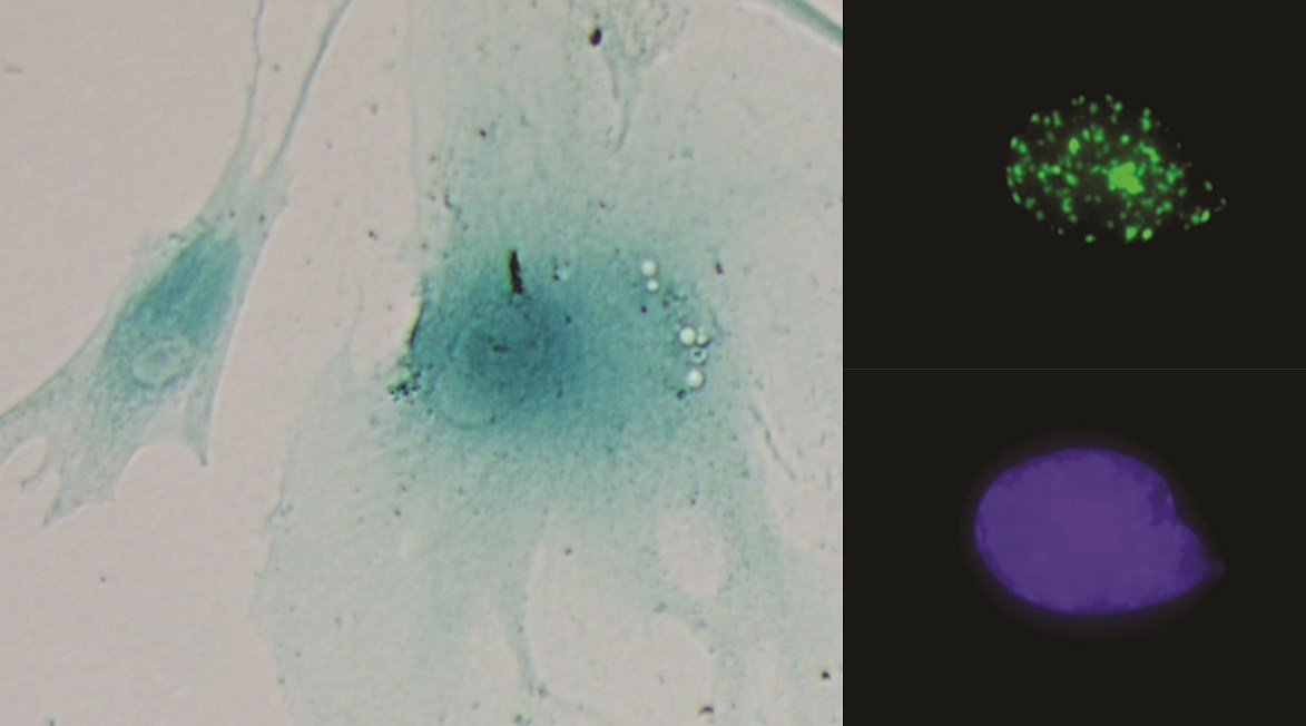 Identifican un nuevo circuito celular que aumenta el crecimiento tumoral en cáncer de colon