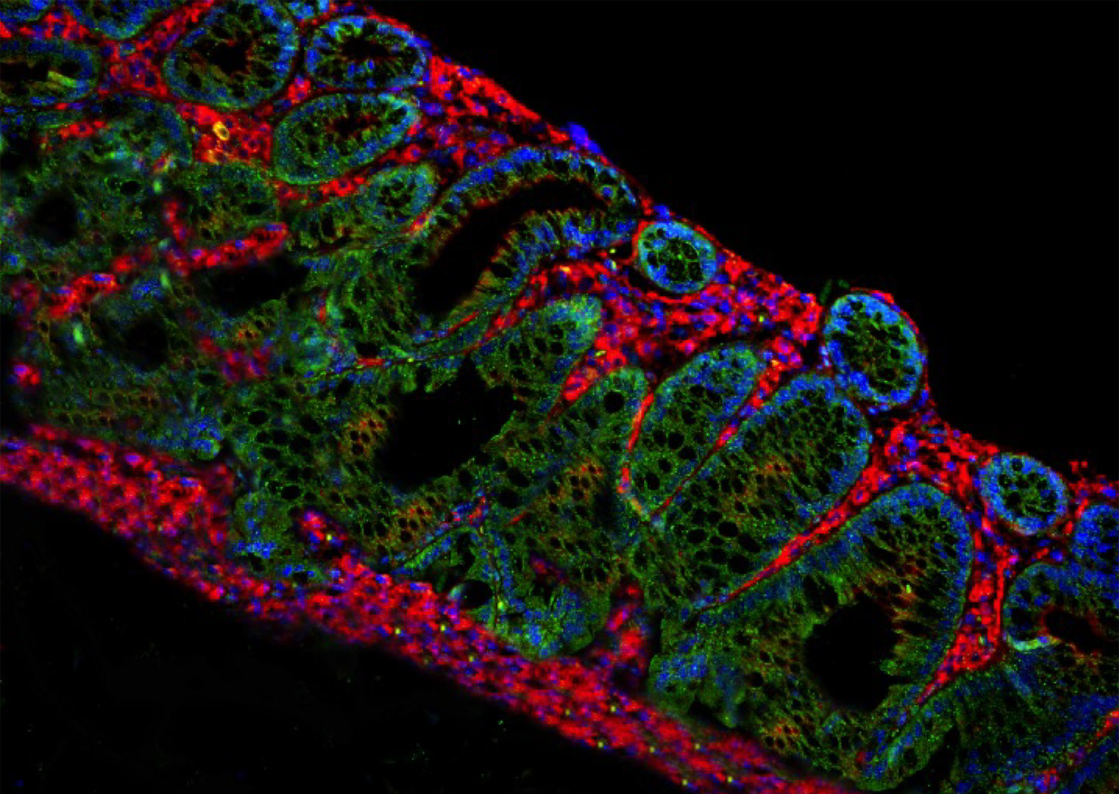 Identifican un mecanismo que promueve la progresión de inflamación crónica hacia cáncer