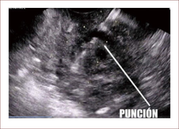 Proponen un nuevo protocolo en la punción endoscópica  en el pancreas