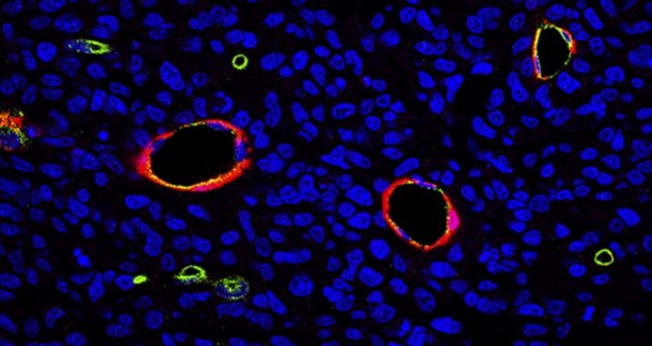 Descubren una conexión entre los gliomas y las enfermedades neurodegenerativas