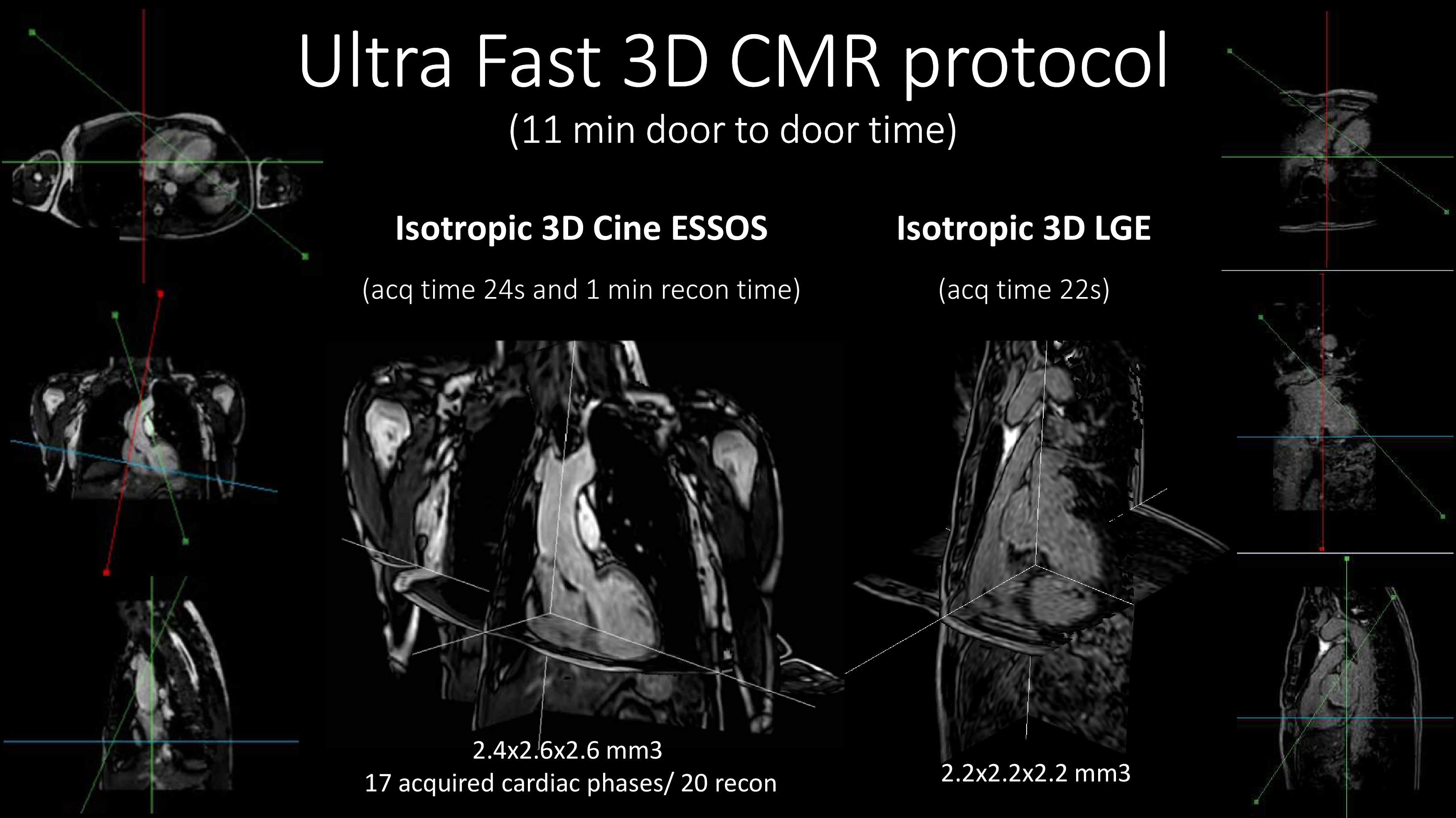 Desarrollan una resonancia magnética cardiaca ultra-rápida que analiza el corazón en menos de 1 minuto