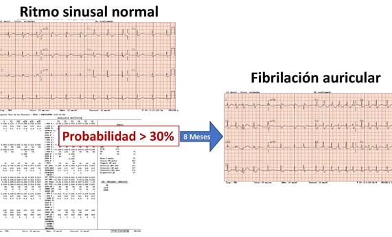 Análisis de electrocardiogramas con big data para predecir el riesgo de fibrilación auricular