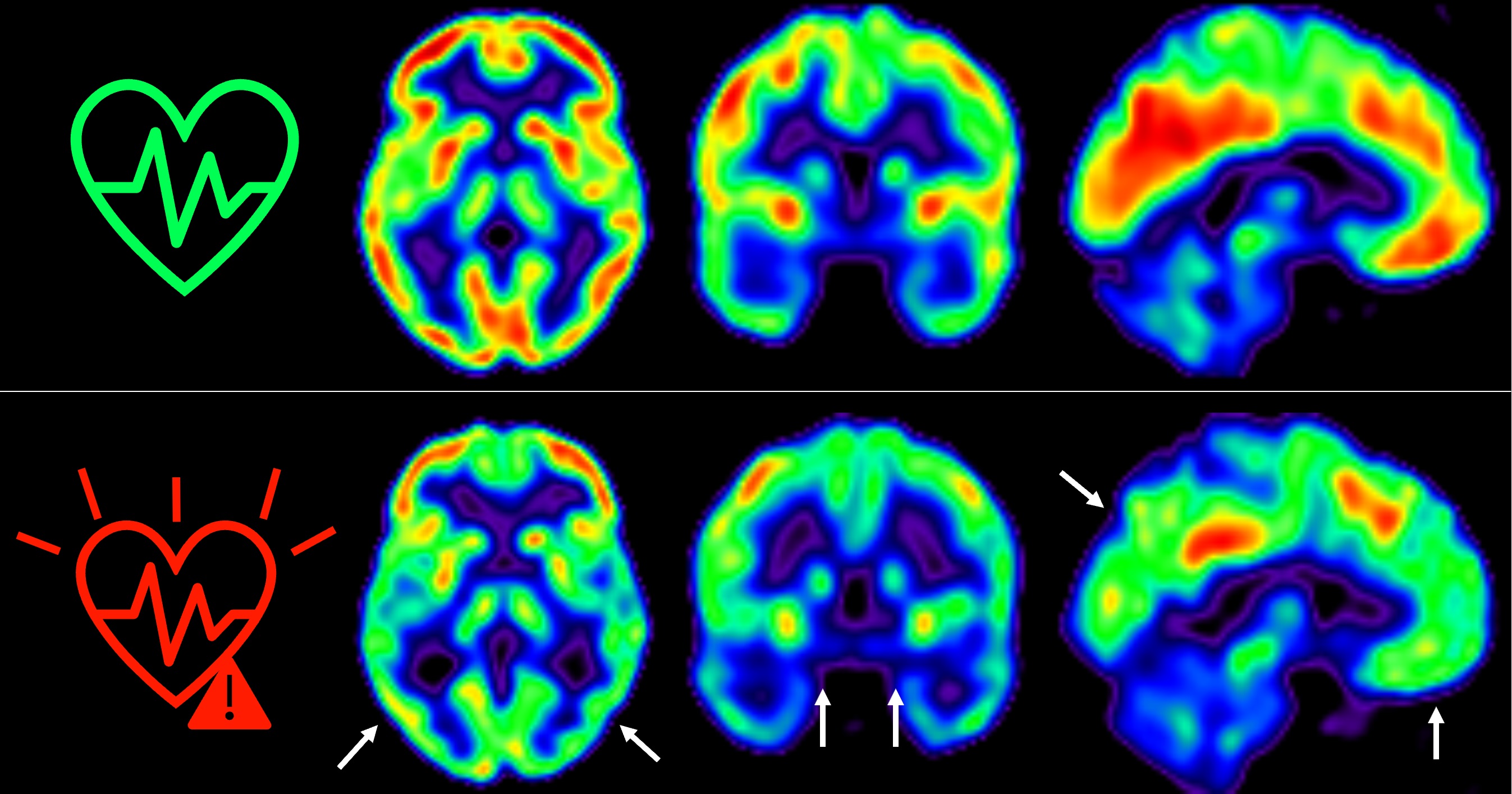 Cuanto antes empecemos a controlar los factores de riesgo cardiovascular, mejor para nuestro cerebro