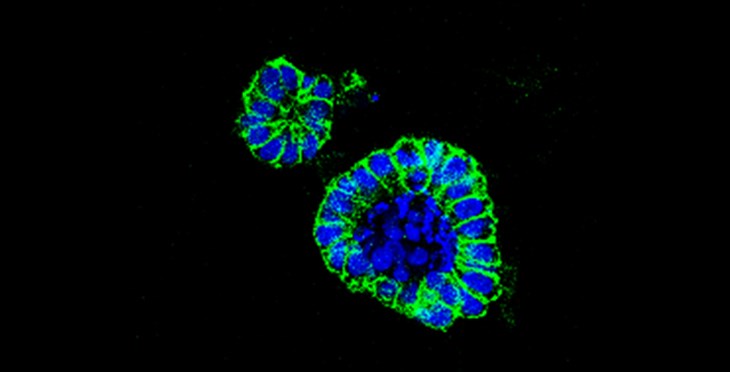 Un nuevo fármaco frente a un transportador de aminoácidos es efectivo en cáncer de colon