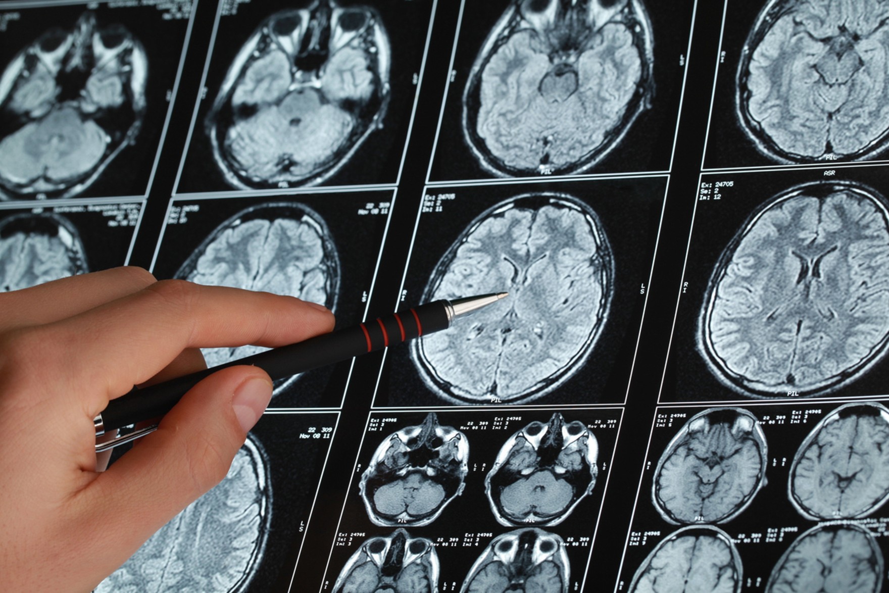El hallazgo de un patrón molecular en enfermedades del cerebro y el intestino abre la vía para mejorar la detección del párkinson