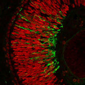 Identifican una nueva posible causa genética de microftalmia