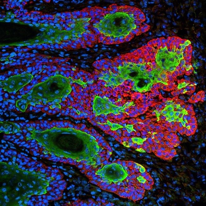 Diseñan nanopartículas que se 'despiertan' con luz ultravioleta para atacar al tumor