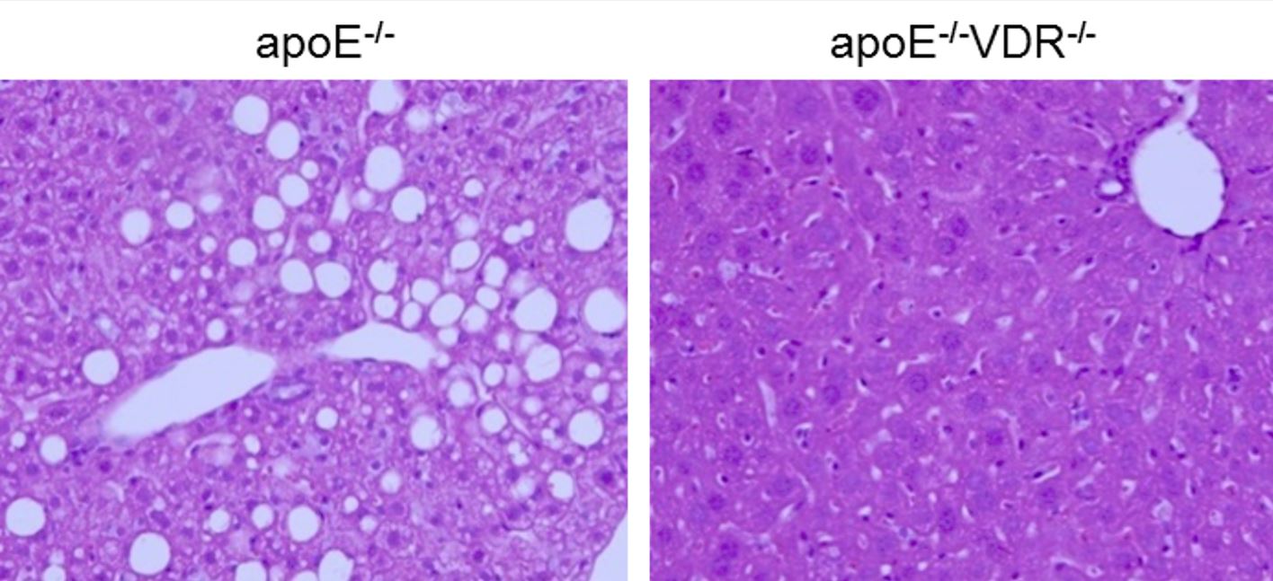 El receptor de vitamina D promueve la esteatosis en la enfermedad del hígado graso no alcohólico