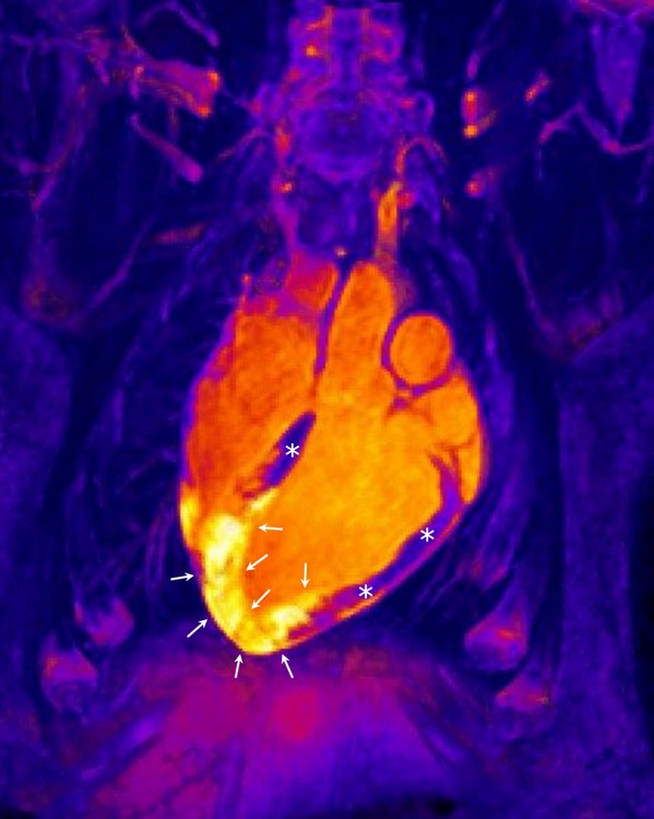 El fin de un dogma sobre la respuesta inflamatoria del corazón infartado podría cambiar su tratamiento futuro